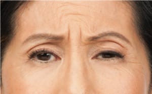 BOTOX in NYC