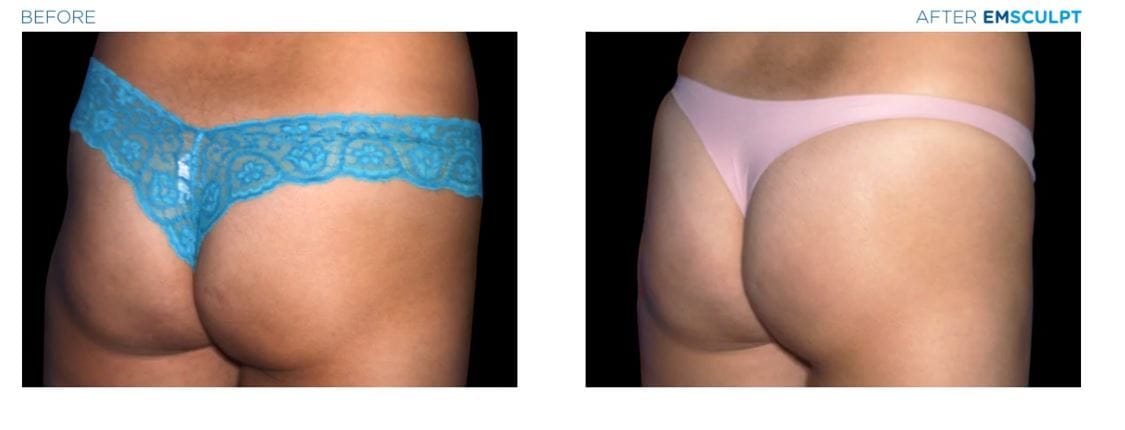 Emsculpt New Jersey