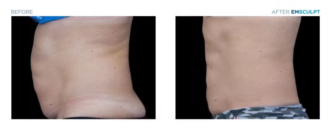EmSculpt NYC