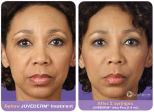 Juvederm in NJ