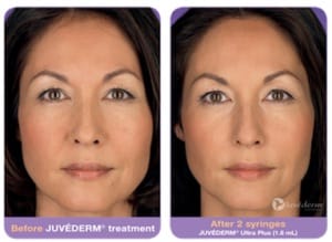 Dermal Fillers NJ