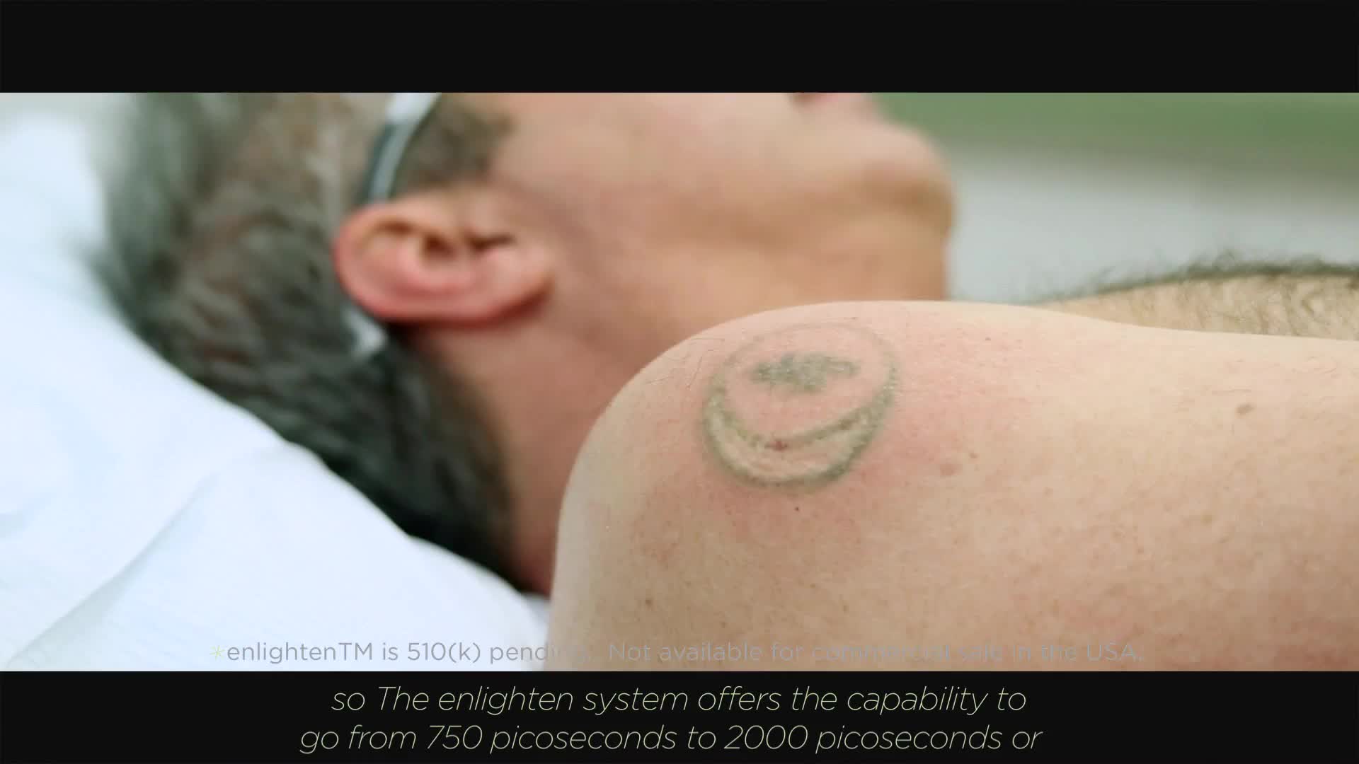 Laser Tattoo Removal in NYC