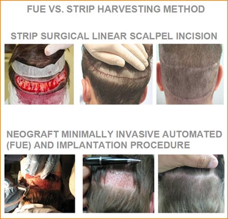NJ neograft