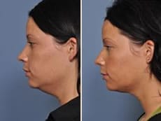 NJ Non Surgical Facelift