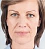 Sculptra Facial Contouring in NYC