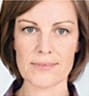 Sculptra Facial Contouring in NYC
