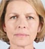 Sculptra Facial Contouring in NYC