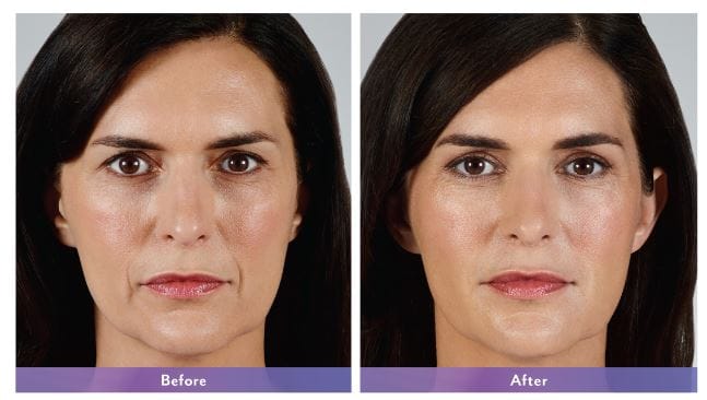 Juvederm Vollure XC NYC