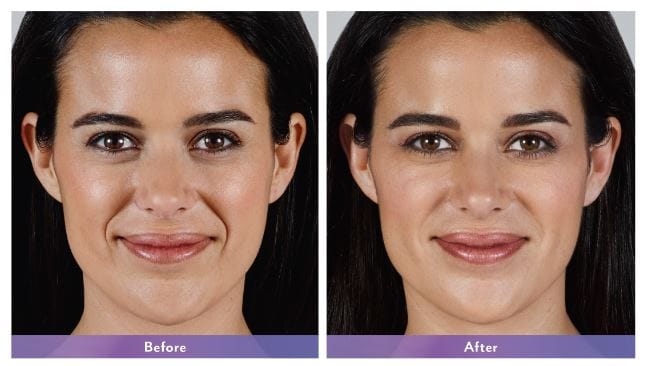 Juvederm Vollure XC NYC