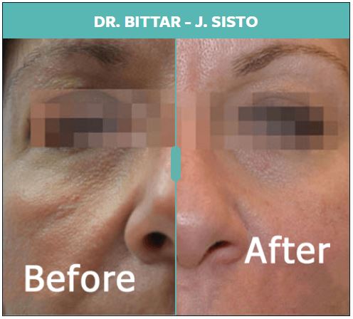 Fractora Skin Rejuvenation NYC